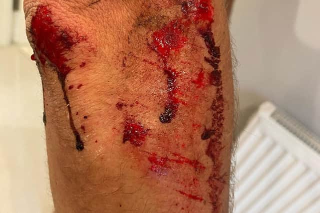 Alpecin-Fenix cylist Alex Richardson’s injuries, which he posted on Instagram. Credit: alexrichitaly/Instagram