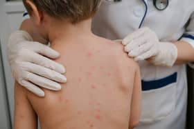 Chickenpox is a viral infection that mostly affects children, but you can get it at any age