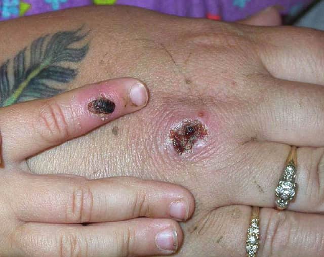 Monkeypox symptoms