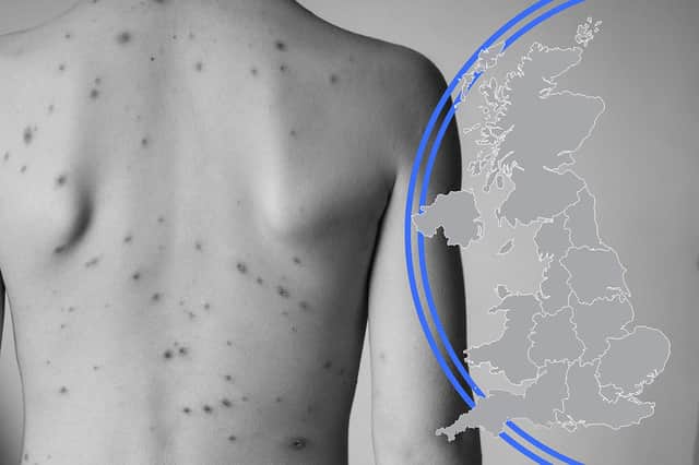Monkeypox causes lesions to develop in the mouth and on the body (Composite: Kim Mogg / NationalWorld)