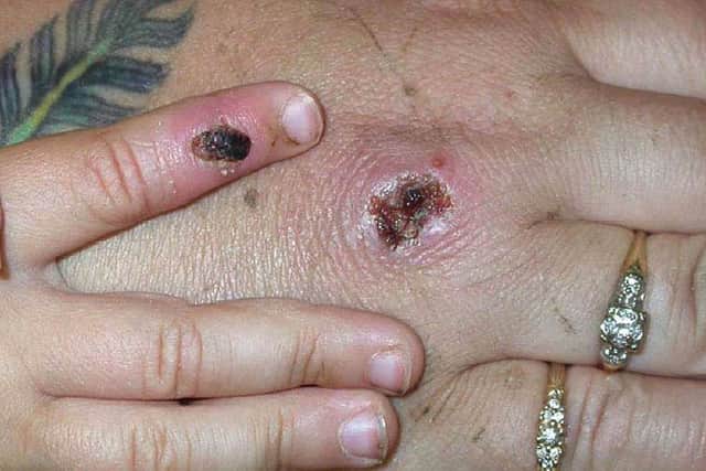 The risk of catching Monkeypox in the UK is said to be ‘low’ (image: Getty Images)