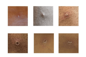 There are currently 20 cases of the monkeypox virus in the UK
