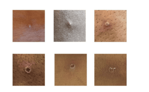 There are currently 20 cases of the monkeypox virus in the UK