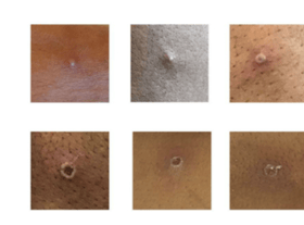 There are currently 20 cases of the monkeypox virus in the UK