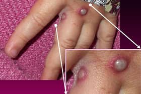 The monkeypox rash changes from raised red bumps, to spots filled with fluid, with the spots eventually forming scabs which later fall off 