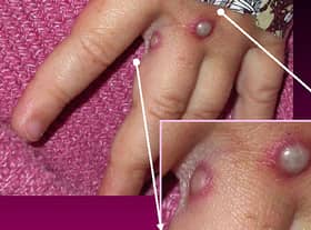 The monkeypox rash changes from raised red bumps, to spots filled with fluid, with the spots eventually forming scabs which later fall off 