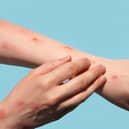 The case definition for monkeypox has been updated by UK health officials to include new symptoms to look out for