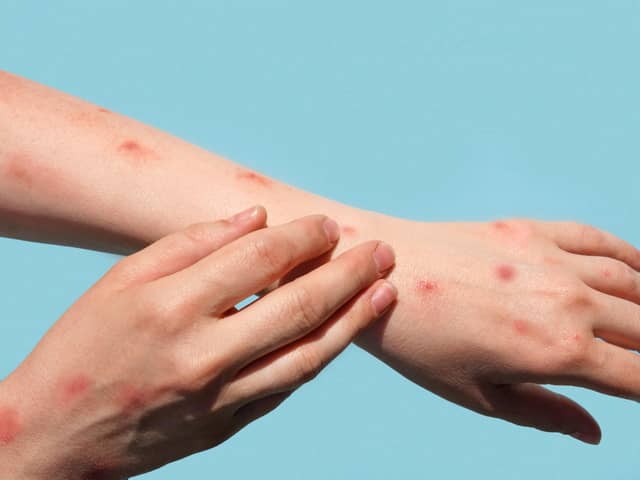 The case definition for monkeypox has been updated by UK health officials to include new symptoms to look out for