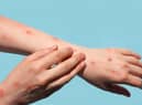 The case definition for monkeypox has been updated by UK health officials to include new symptoms to look out for