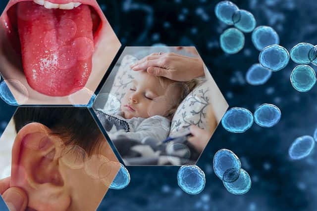 Invasive Group A Streptococcal disease (iGAS or Strep A) is known to cause scarlet fever, throat infections and, in very rare cases, invasive disease