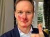 Dan Walker shares update after having ‘no memory’ of collision with car as he urges cyclists to wear helmets