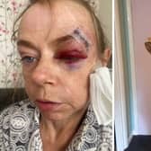 Lorna Martin suffered an injury to her head after tripping on a hole in her shower. Other issues with her Lewisham home included cracks in the walls and damaged doors. Credit: Inked PR.