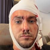 Bradley Richards, 29, was left with six fractures in his spine and neck and internal bleeding