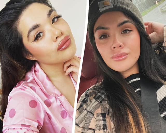 Lorna Holmes with lip filler and after it was dissolved.