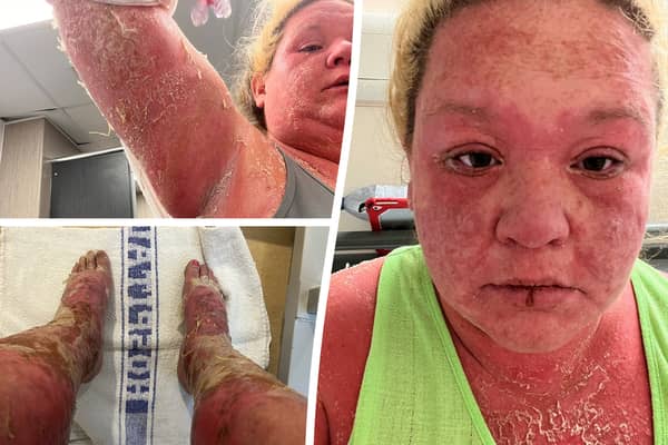 Woman's extreme allergic reaction to mosquito bite on holiday in the Caribbean 