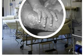 The WHO has declared a global health emergency over a mpox outbreak. (Photo: Pixabay, CDC/Getty Images)