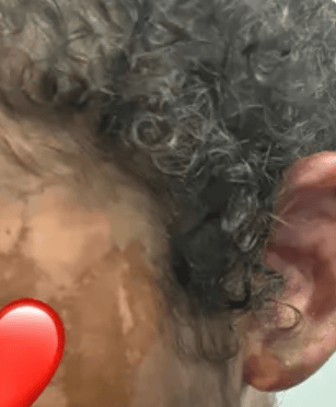 The girl's father has posted pictures of her injures on a GoFundMe page