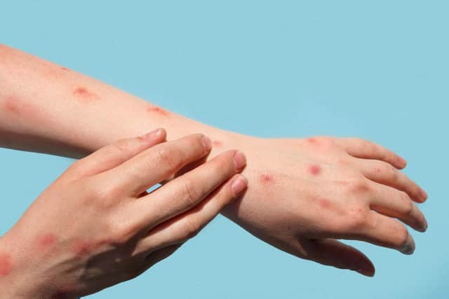 A fifth UK case of mpox Clade Ib has been found in Leeds