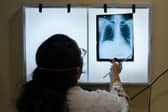 Tuberculosis (TB) cases in England have increased by 13%.