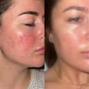 These are before and after images of Jamie, another 47 Skin user