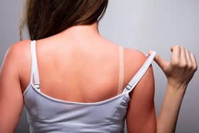 Woman with sunburn.