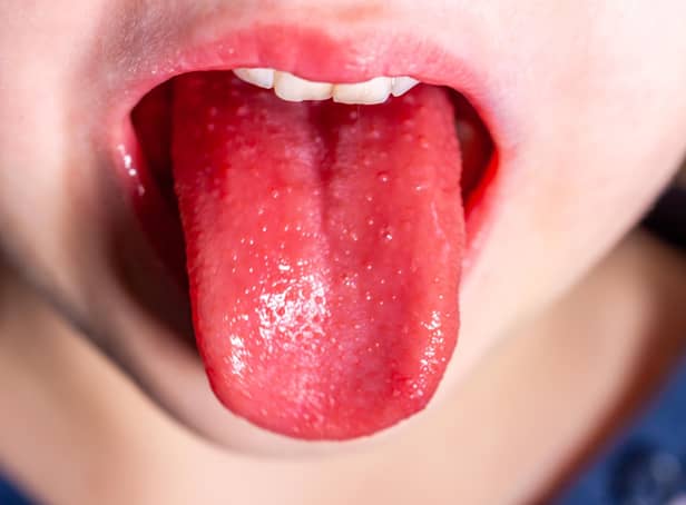 <p>Tongue of a child with scarlet fever - strawberry tongue.</p>