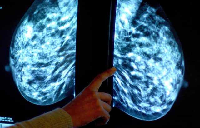 Breast screening uptake in south west London remains below pre-pandemic levels