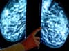 More than 15,000 Brent women miss "vital" breast cancer screenings