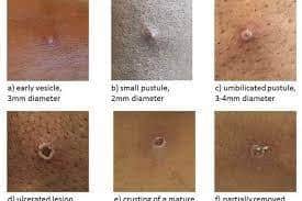 Monkeypox has been declared as a global health emergency