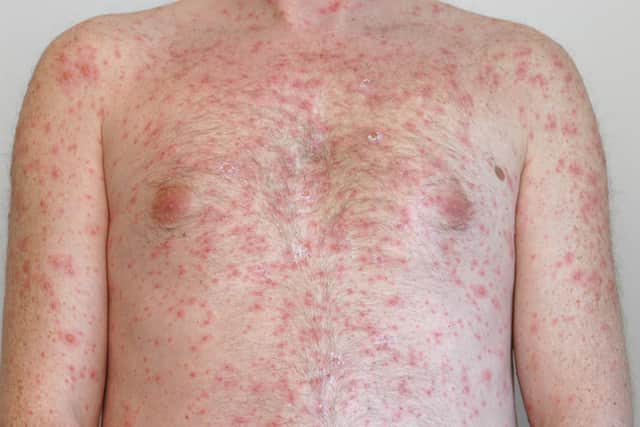 The skin rash caused by measles.